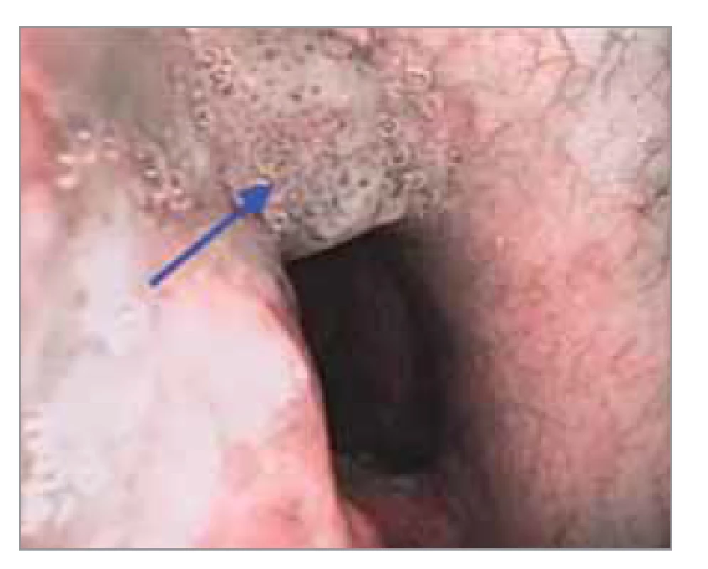 Stav po radioterapii glotického
karcinomu hrtanu cT2N0M0,
patologická vaskularizace IPCL
typu IV v oblasti zadní komisury, ambulantní
flexibilní endoskopie s NBI,
histologicky karcinom in situ.<br>
Fig. 4. Condition after radiotherapy
of glottic carcinoma of the larynx
cT2N0M0, pathological vascularization
of IPCL type IV in the area of the posterior
commissure, outpatient flexible
endoscopy with NBI, histological carcinoma
in situ.