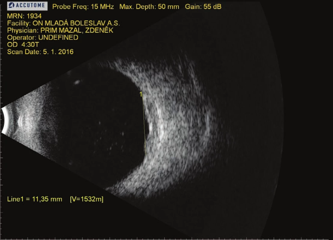 a. US-B peripheral lesions in LE