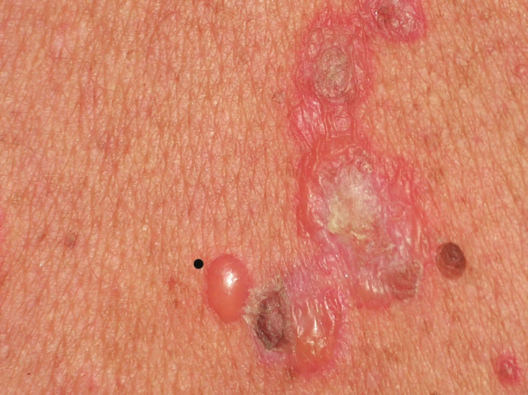 Vícečetné buly při onemocnění ze skupiny bulózních dermatóz
V levém dolním kvadrantu je čerstvá bula s napnutou krytbou,
tečkou je vyznačeno místo, které by bylo vhodné k perilezionálnímu
odběru vzorku pro vyšetření přímou imunofluorescencí.
Vpravo a nahoře jsou buly staršího data se sekundárními změnami,
které k odběru vhodné nejsou.
