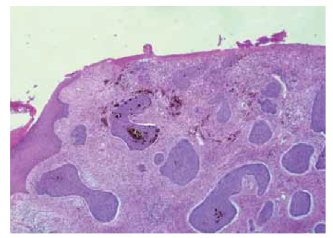 Pigmentovaný bazocelulární karcinom.<br>
Fig. 8. Pigmented basal cell carcinoma.