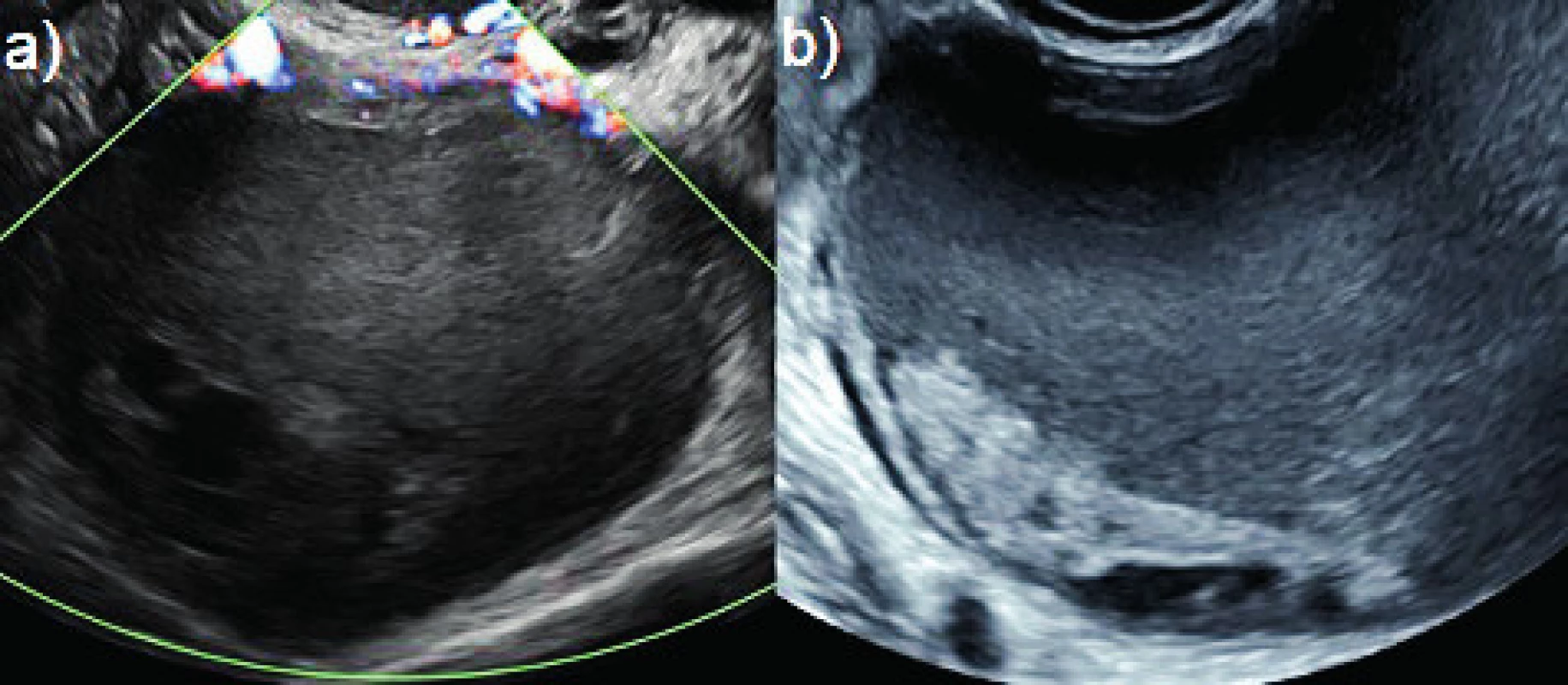 Endometroidní cysty atypického vzhledu<br>
(a) unilokulární cysta s nehomogenním obsahem s perfuzí pouze
v pouzdru; (b) unilokulární cysta s detritem přisedlým při její stěně,
který odpovídá krevních koagulům, nejedná se o nádorovou solidní
prominenci.