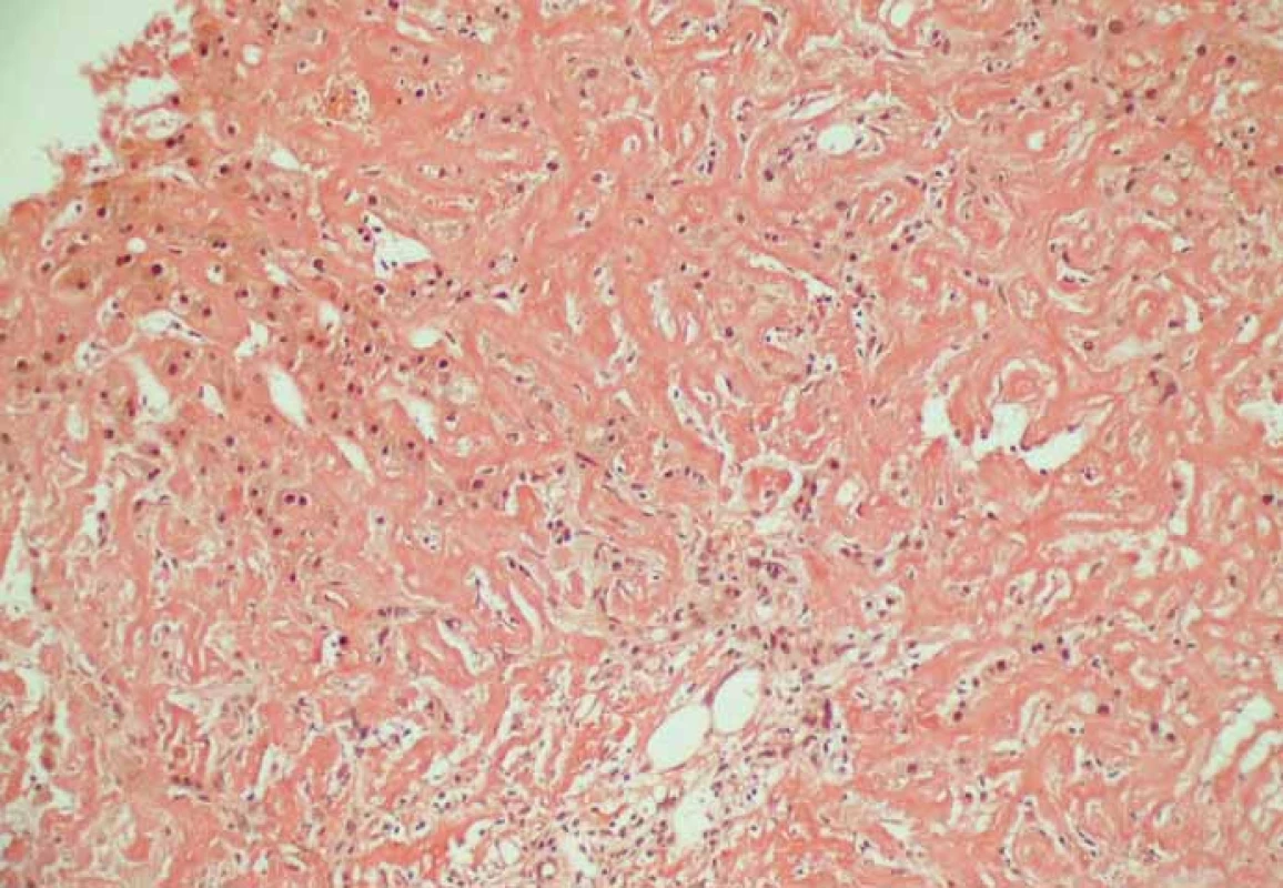 Amyloid, barvení kongo červení.
Fig. 2. Amyloid, Congo red staining.