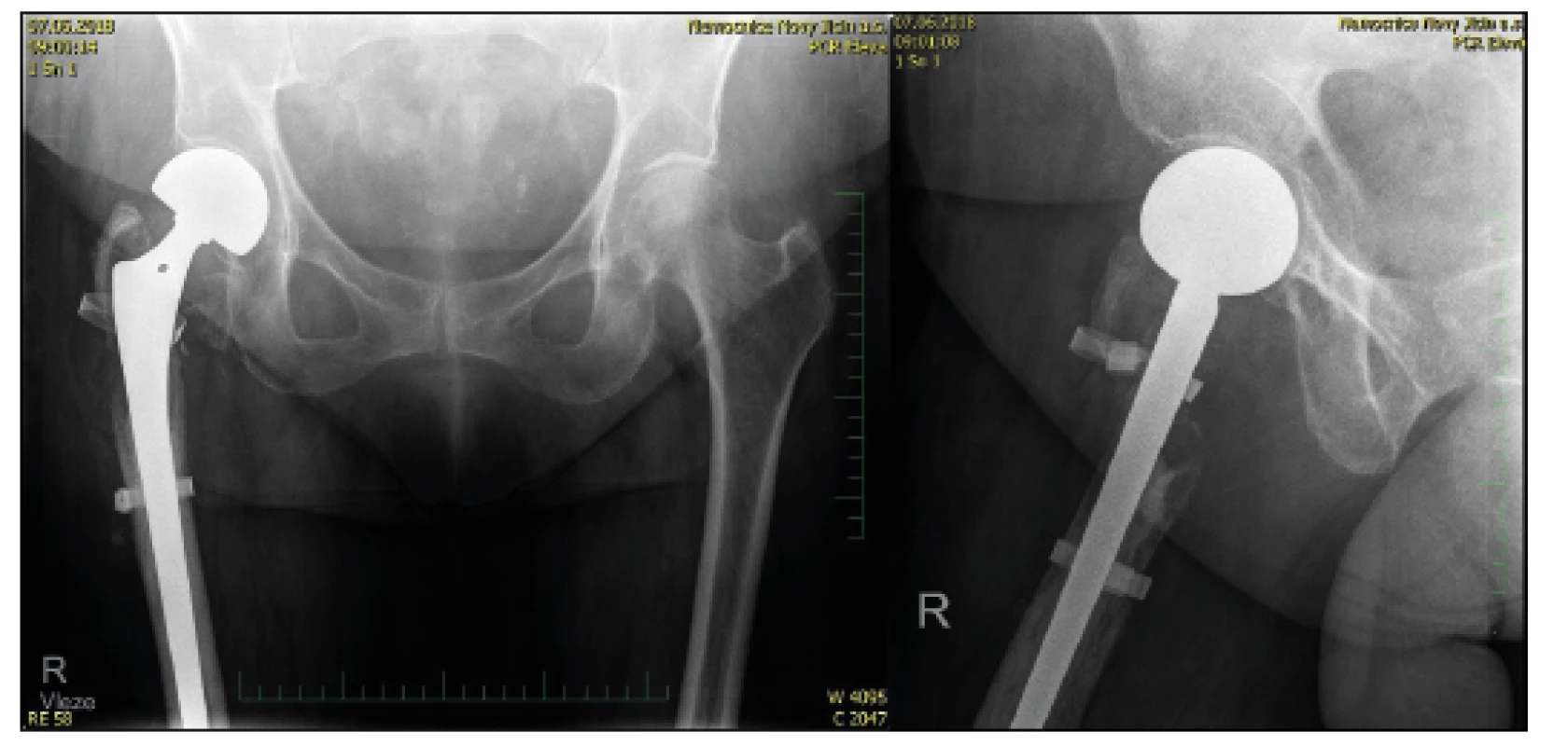 76letá žena s tříštivou zlomeninou trochanterického masivu,
kontrolní RTG po implantaci CKP s pojistnou cerkláž