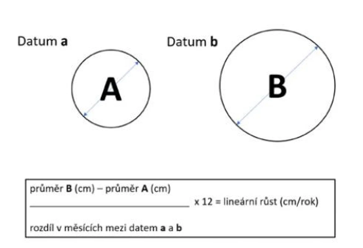 Rovnice pro výpočet lineárního růstu nádoru
ledviny; upraveno podle Sebastia et al. (27)<br>
Fig. 2. Calculation of the linear growth rate of a renal
tumor; adapted from Sebastia et al. (27)