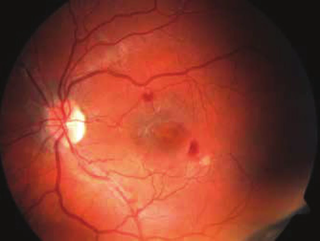 Fundus leucaemicus: intraretinal haemorrhage, soft exudates
and Roth's spots