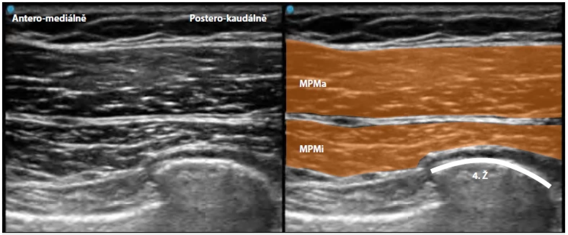 Interpectoral Plane a Pectoserratus Plane Block