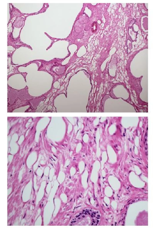 Hyperplazie prostatických žlázek a komponent
stromatu s ložisky zralé metaplastické fibrolipomatózní
tkáně (A – hematoxylin‑
eosin, 100×); detail
ložiska fibrolipomatózní metaplazie (B – hematoxylin‑eosin,
×400)<br>
Fig. 1. Hyperplastic prostatic glands and stromal
components with foci of mature metaplastic fibrolipomatous
tissue (A – hematoxylin‑
eosin, ×100); focus
of the metaplastic fibrolipomatous tissue in detail
(B – hematoxylin‑
eosin, ×400)
