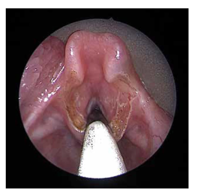 Laryngomalacie hrtanu – pooperační nález po rozrušení
a částečné redukci aryepiglotických řas pomocí CO2
laseru.<br>
Fig. 4. Laryngomalacia – postoperative findings after discision
and partial reduction of aryepiglottic folds using a CO2
laser.
