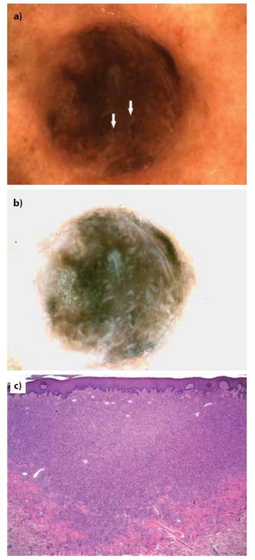 Pacientka, 80 let, hemosiderotický fibrózní histiocytom
z přední strany levého bérce<br>
a) dermatoskopický obraz s přítomností jasných bílých
proužků (šipky)<br>
b) normalizovaný dermatoskopický obraz, který jasné bílé
proužky zvýrazní<br>
c) histopatologický obraz (HE, 25x).