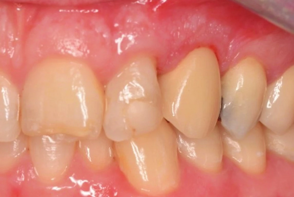 Okluzní pohled na definitivní
práci in situ<br>
Fig. 4
Clinical view of definitive
crown, oclusal view