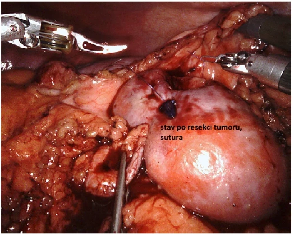 Stav po resekci tumoru a naložení stehu <br> 
Fig. 7. Status after tumour resection and suture placement