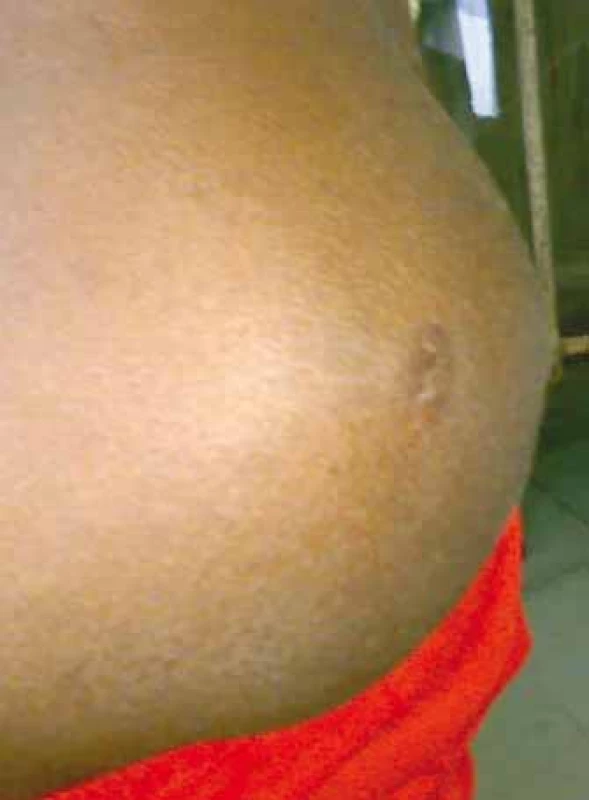 Alveolar rhabdomyosarcoma present
at the left gluteal region of a 3-year-
-old child.