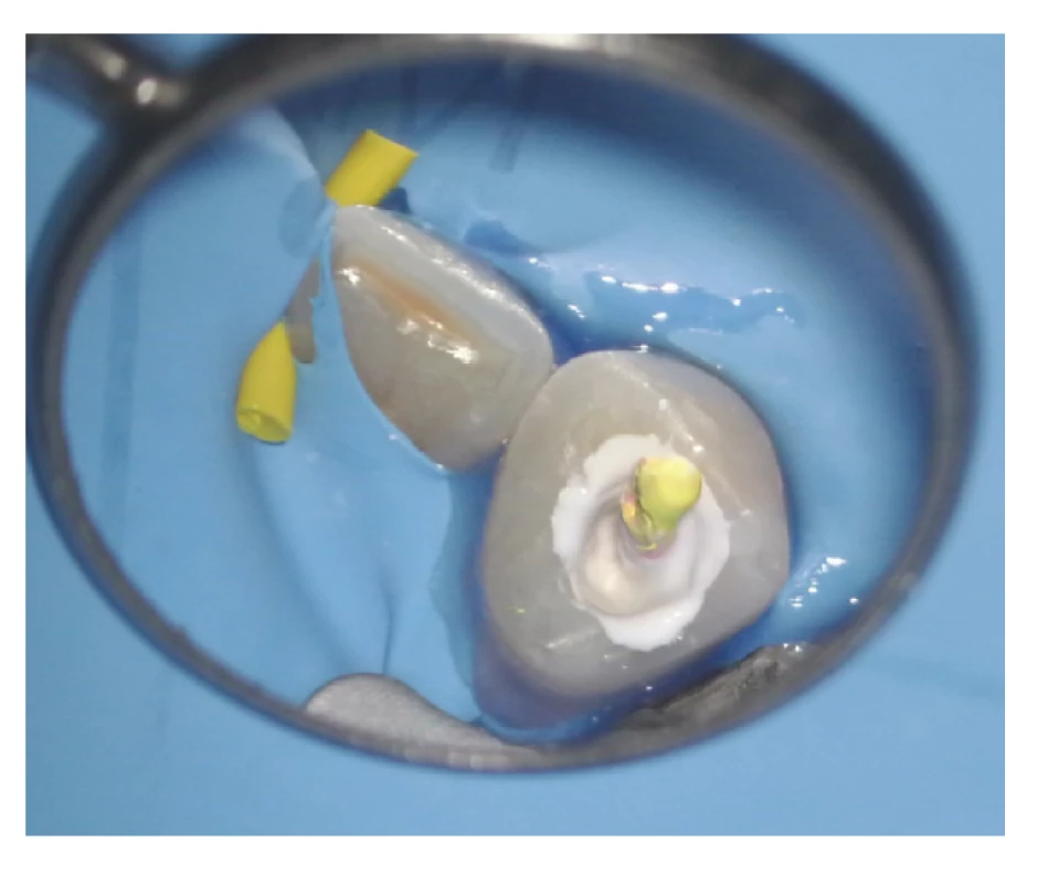 Pohled do dřeňové dutiny zubu, kanálek byl vyplněn fillerem a kalibrovaným gutaperčovým čepem <br>
Fig. 4 Root canal filled with calibrated gutta-percha cone and bioceramic-based sealer in abundance
