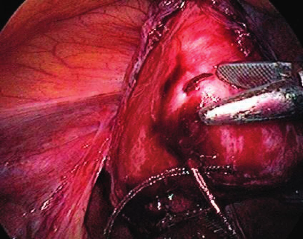 Implant fixation on vaginal stump