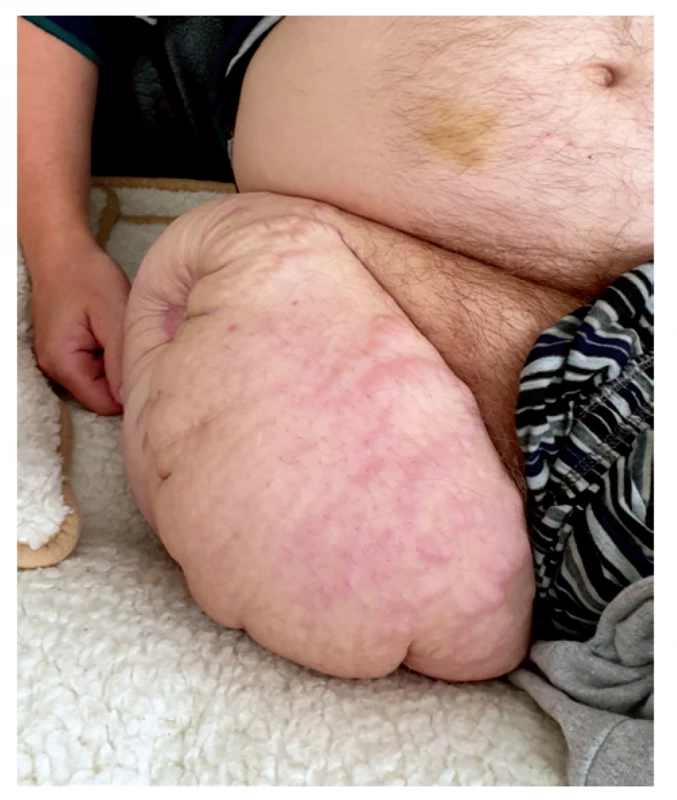 Zahojený pahýľ pravej dolnej končatiny po vysokej
amputácii<br>
Fig. 4: Healed stump of the right lower limb after transfemoral
amputation