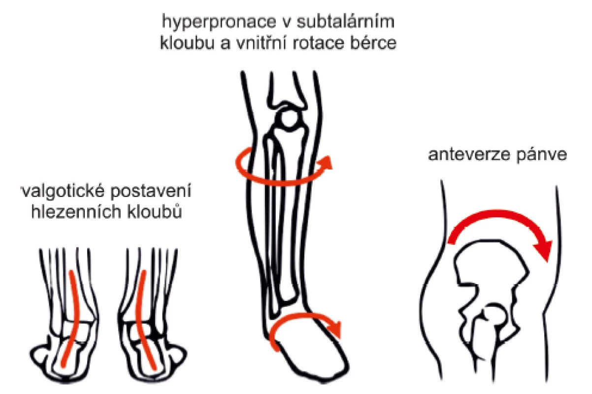 Distoproximální řetězení změn při zvýšené pronaci zánoží