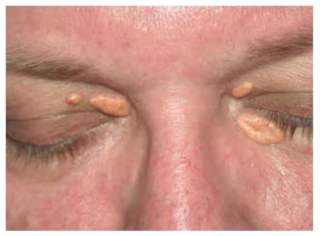 Xanthelasma palpebrarum