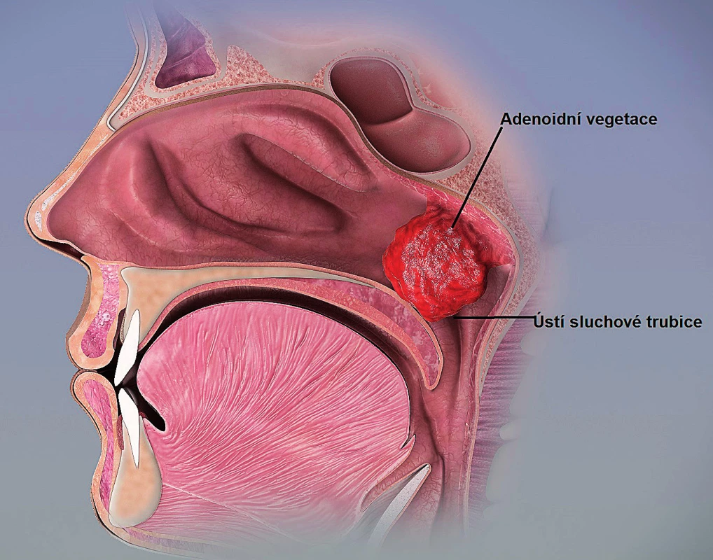 Vztah adenoidní vegetace a ústí sluchové trubice
(upraveno dle https://en.wikipedia.org/wiki/Adenoid_
hypertrophy).