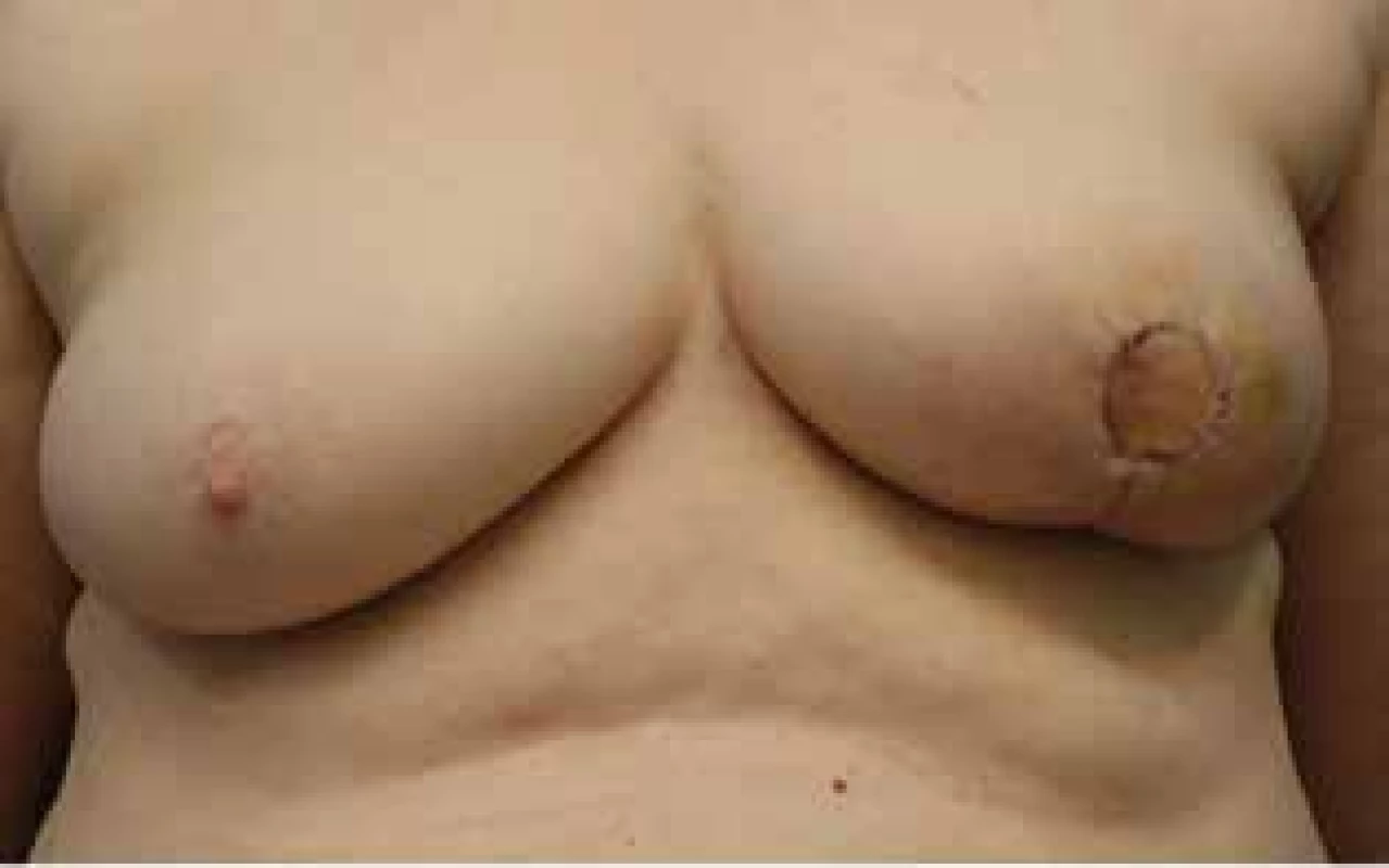 Rekonstrukce/imitace AMK Grisottiho lalokem<br>
Fig. 4: Reconstruction/immitation of NAC using the Grisotti
flap