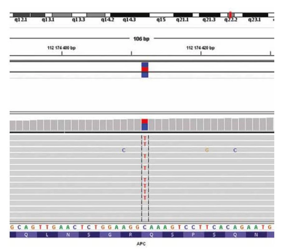 Obrázek zobrazující mutaci v APC genu detekovanou (v odoperovaném
nádoru) pomocí sekvenování nové generace a vizualizovanou programem
Integrative Genomics Viewer.