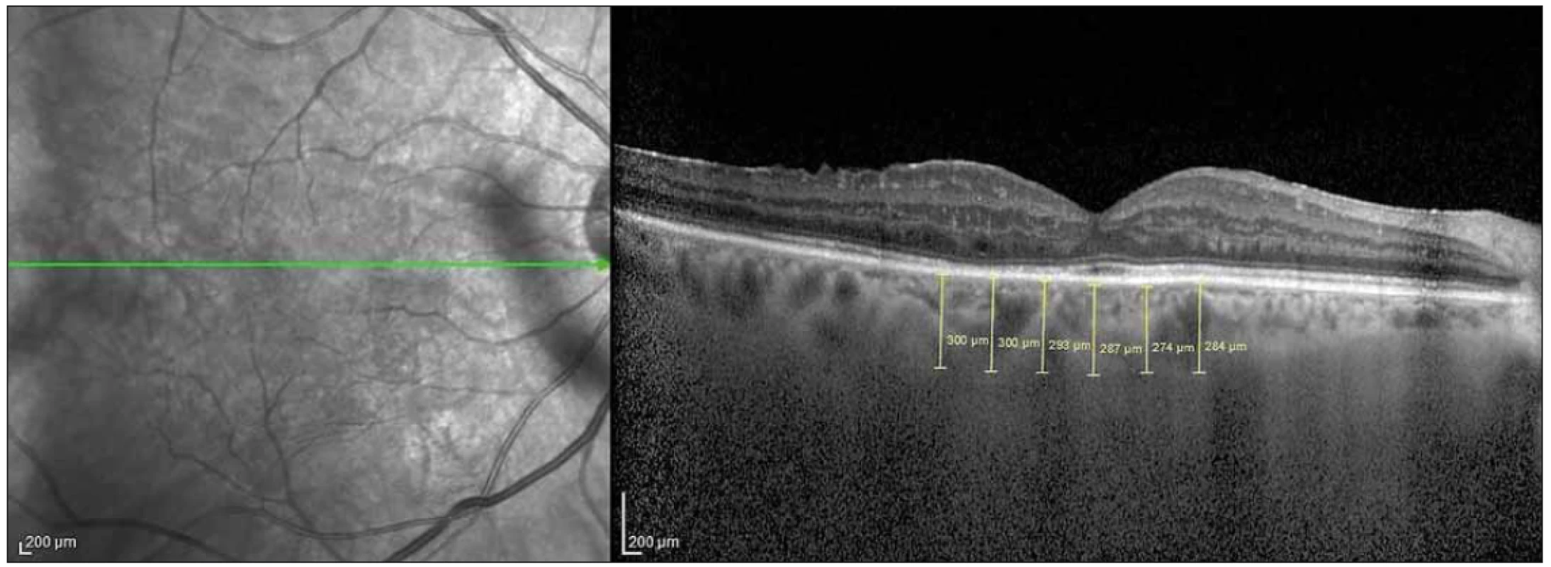 Choroidal thickness measurement at 6 points with 500-μ intervals on the optic coherence tomography section.<br>
Obr. 2. Měření choroidální tloušťky v 6 bodech s intervaly 500 μ na řezech z optické koherentní tomografie.