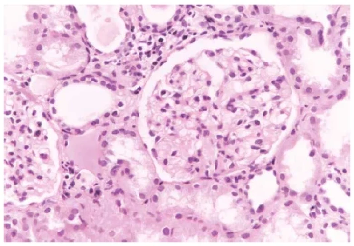 Glomerulus s normální buněčností, bez proliferace. Přilehlé okolí
s rozšířeným intersticiem s mírným zánětem a kanálky s oploštělou výstelkou.
Barveno hematoxylinem eosinem (zvětšení 200x).