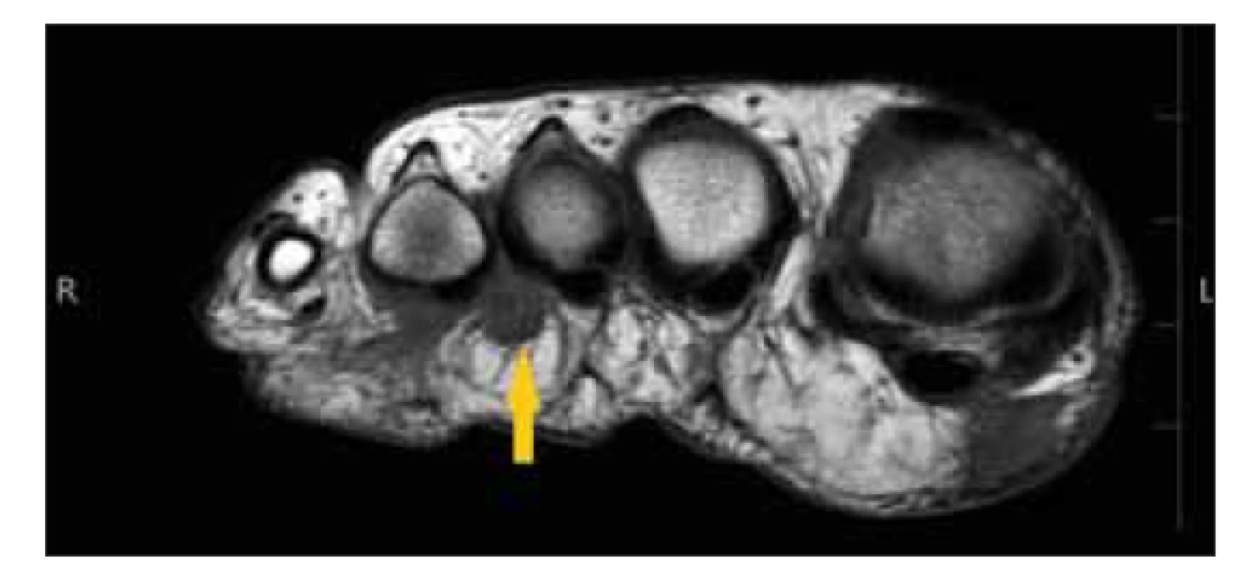 MR, T1-vážený obraz. Mortonův neurom (šipka).<br>
Fig. 2. MRI T1-WI. Morton‘s neuroma (arrow).