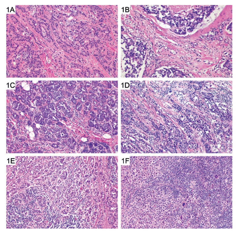 Příklady denzity tumor infiltrujících lymfocytů (TIL) u karcinomu prsu (HE, 200x) (nejedná se o referenční standardy). Zcela ojedinělé TIL
(hodnoceno jako 0 %) (A). Sporadické lymfocyty v části stromatu (hodnoceno jako 10 %) (B). Disperzně přítomné lymfocyty - hodnoceno jako
20 % (C) a 30 % (D). Četné stromální lymfocyty - hodnoceno jako 60 % (E) a > 90 % (F).