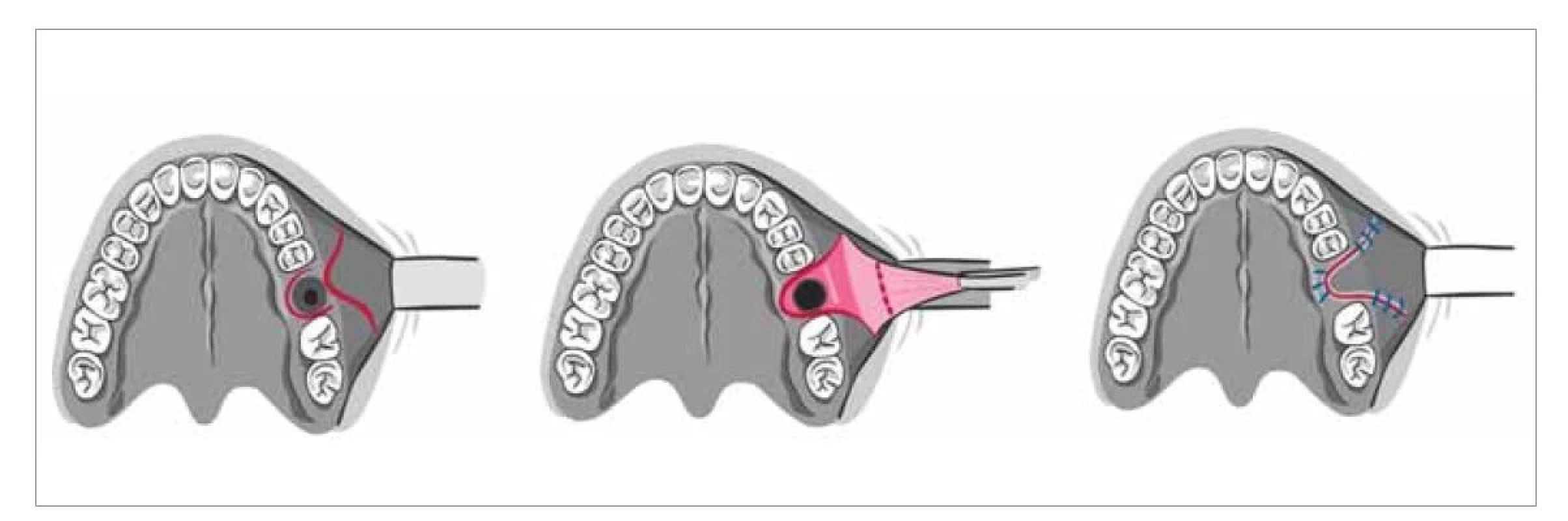 Tvářový lalok.<br>
Fig. 3. Buccal flap.
