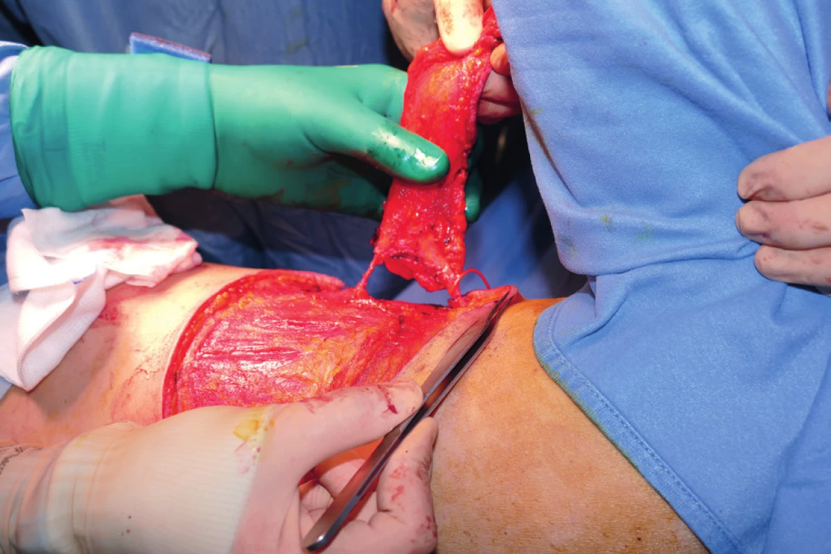Flap harvested on one lateral intercostal artery perforator
and one lateral thoracic artery perforator. The distal one (LICAP)
was later clipped