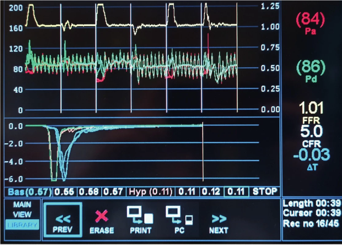 Patologická hodnota indexu mikrovaskulární rezistence (IMR = 33)
vypočítaná z hodnoty Pd a Tmn (Hyp) vyznačenými červeně, resp. žlutě