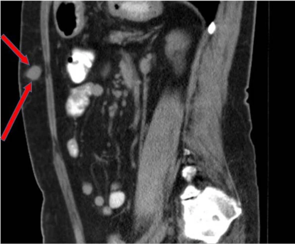 Metastáza v oblasti podkoží
břišní stěny dle CT zobrazení z druhé
poloviny května 2016<br>
Fig. 3. Metastasis in the abdominal
wall subcutaneous – CT May, 2016