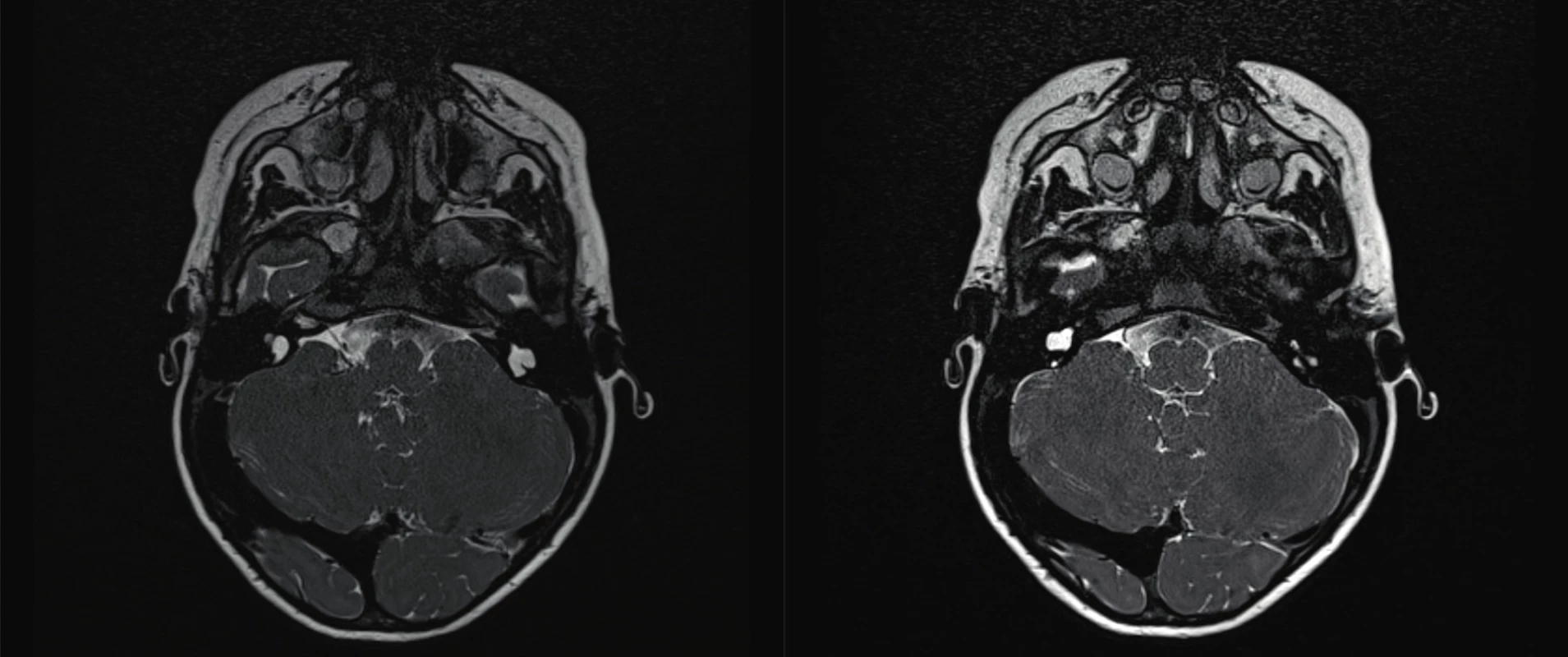 Common cavity – malformace kochley.<br>
Fig. 2. Common cavity malformation of kochlea.