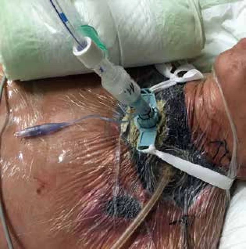 Vyvedenie tracheostomickej kanyly cez nasadený systém na hojenie rán s negatívnym podtlakom (NPWT) v rane na krku <br>Fig. 4: Tracheostomy cannula insertion through negative pressure wound therapy system (NPWT) on the neck