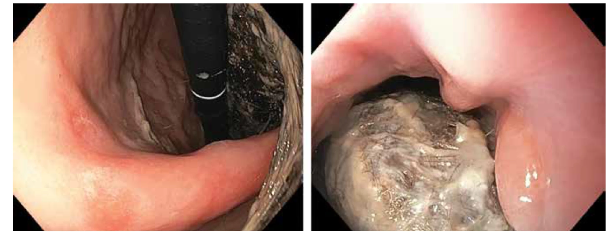 Gastroskopický nález - objemný trichobezoár vyplňující žaludek a zasahující do bulbu duodena.<br>
Fig. 2. Gastroscopy: large trichobezoar fills gastric lumen and extends to duodenal bulb.