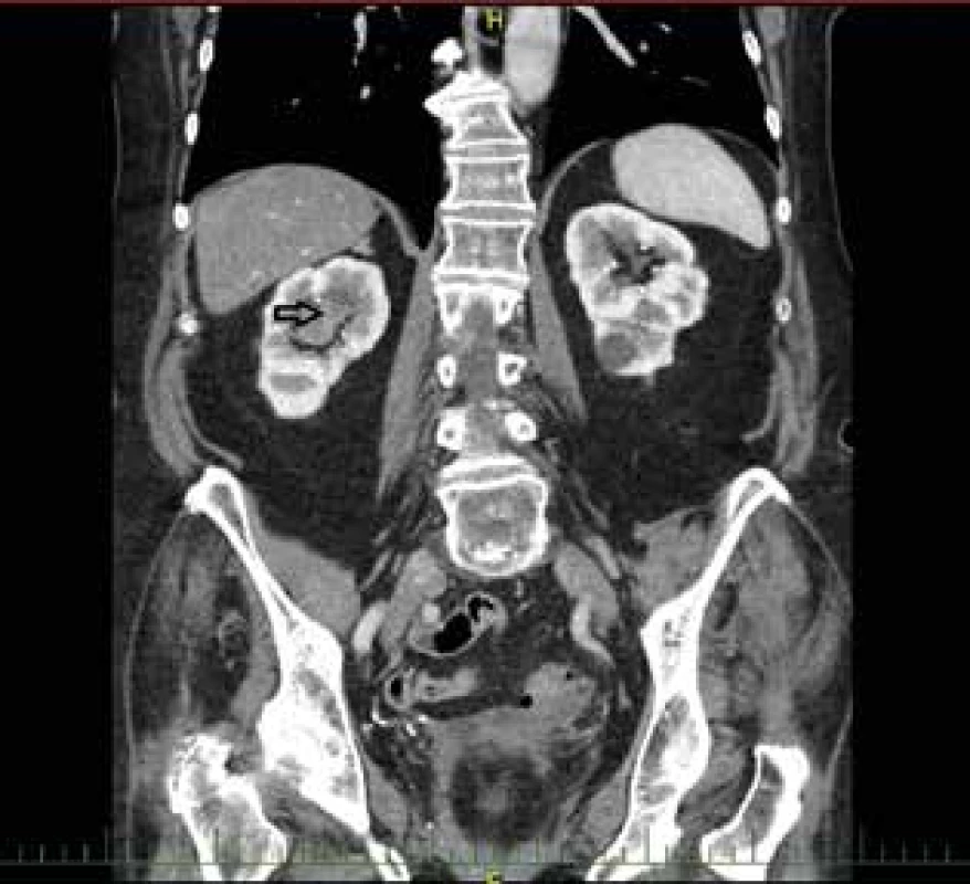  Uroteliální karcinom pánvičky pravé ledviny – CT<br>
Fig. 5: Urothelial carcinoma of the renal pelvis of the right
kidney – CT
