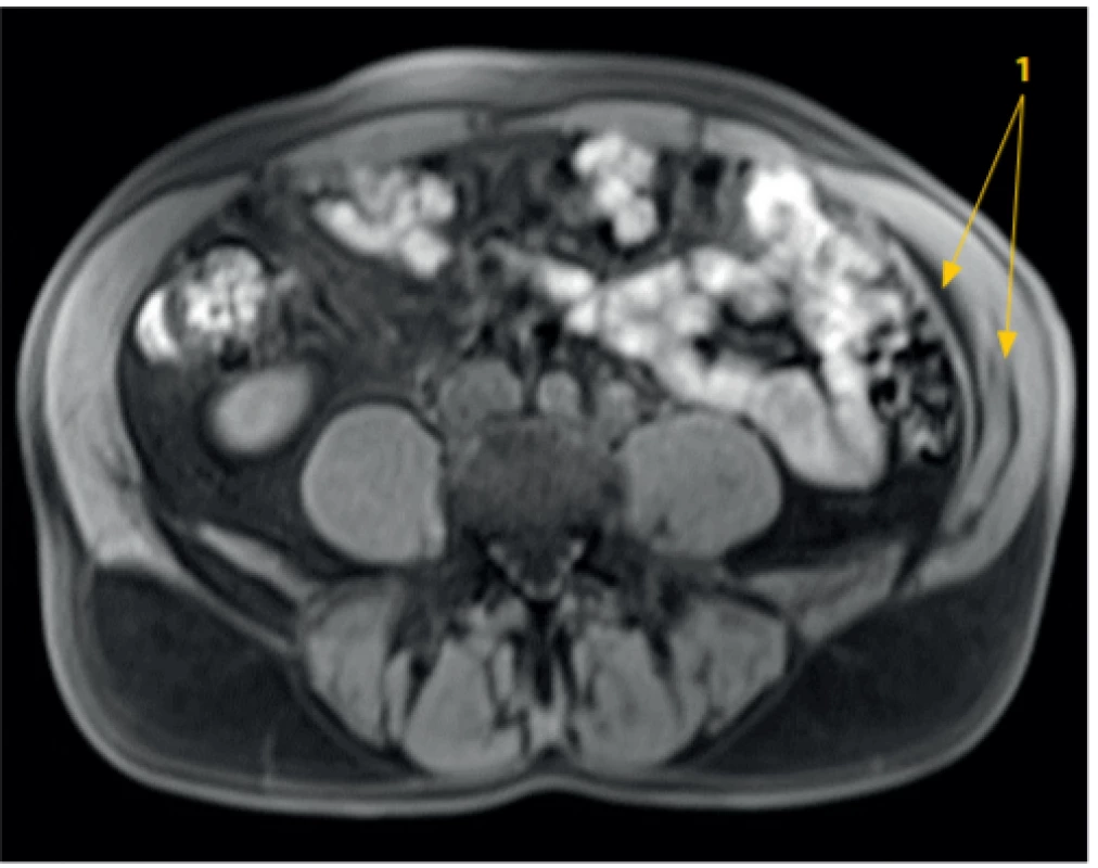 CT obraz TAP bloku pod UZ kontrolou: 15 ml fyziologického
roztoku. Tekutina (1) oddělila m. transversus abdominis od m. obliquus
abdominis a částečně pronikla mezi m. obliquus internus a externus