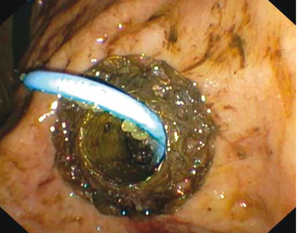 Horní endoskopie – proximální (gastrická) část lumen
apozičního metalického stentu, v jehož lumen je zavedený
plastový double pig-tail stent.<br>
Fig. 3. Upper endoscopy – the proximal (gastric) part of the
lumen aposition metallic stent in which the plastic double
pig-tail stent is inserted.