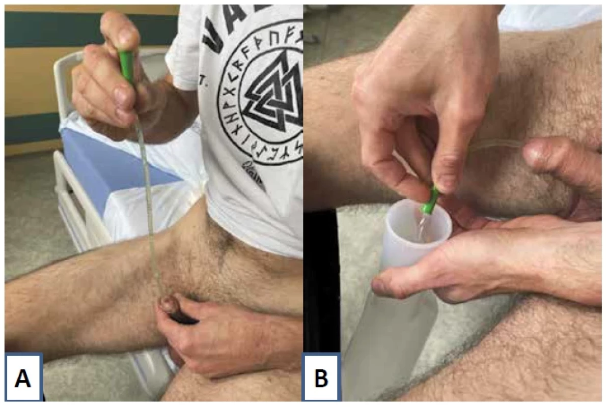 Při čisté intermitentní katetrizaci se po hygieně zevního meatu uretry zavede jednorázový katétr
do uretry bez používání sterilních rukavic (A). Poté, co se moč vypustí do vhodné sběrné nádoby, se katétr
zase odstraní (B)