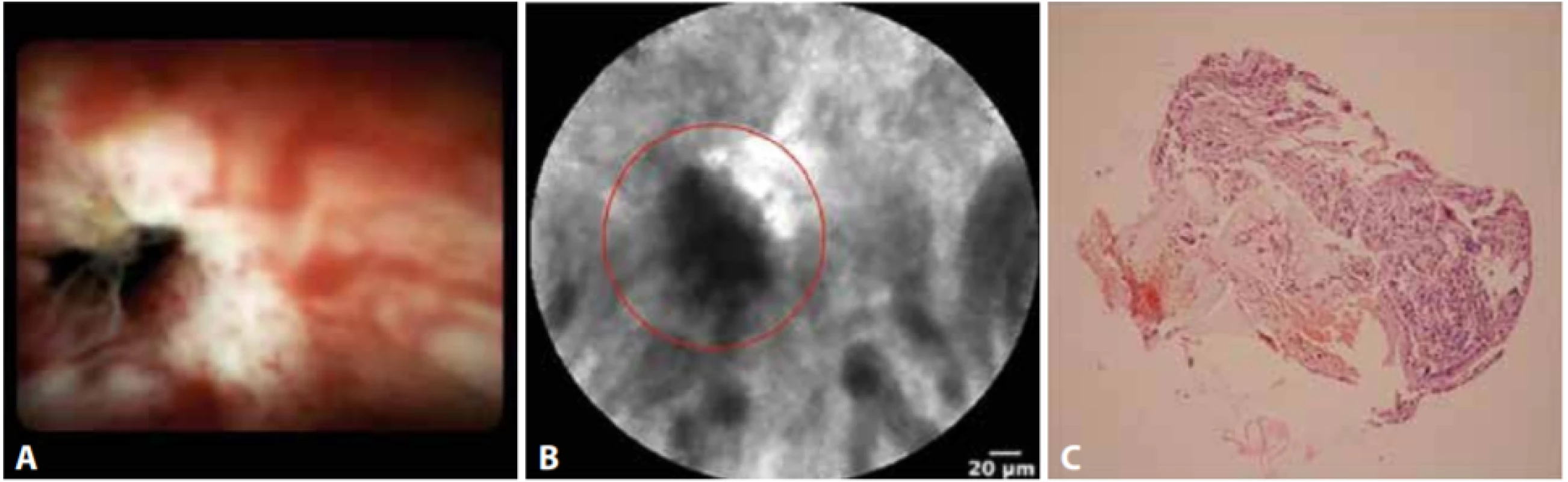 Pacient s cholangiokarcinomem
A − cholangioskopický obraz, B − pCLE a C − histologický obraz. V CLE obraze patrné tmavé shluky a široké tmavé pruhy typické
pro cholangiokarcinom.<br>
Fig. 1: Patient with cholangiocarcinoma
A − cholangioscopy; B – pCLE; and C − histology. CLE image shows dark clumps and thick dark bands typical for cholangiocarcinoma.
