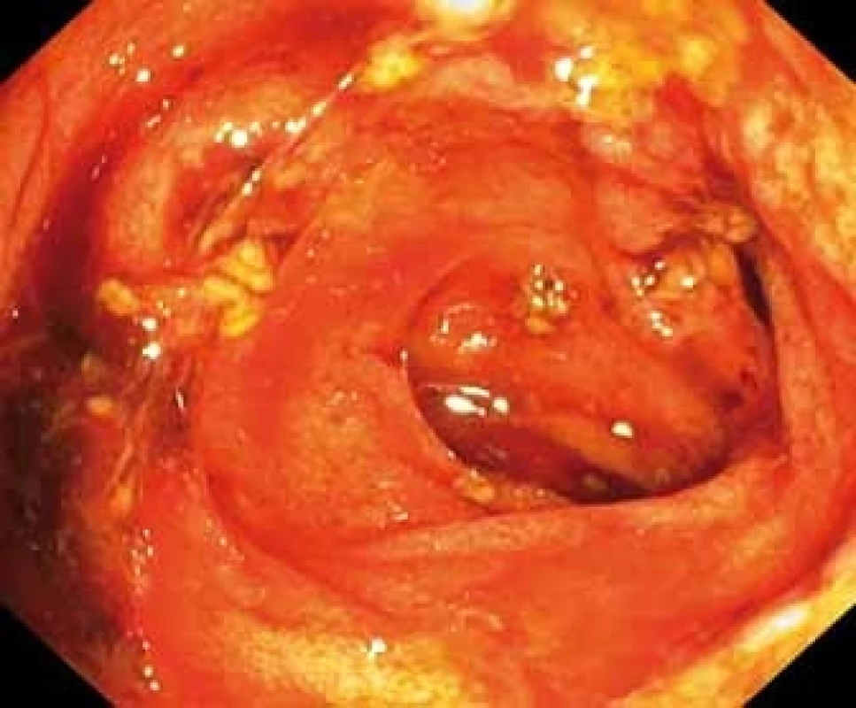 Terminalní ileum s přítomností krve a ulcerací s fibrinem.<br> Fig. 1. Terminal ileum with blood and fibrin on ulceration.
