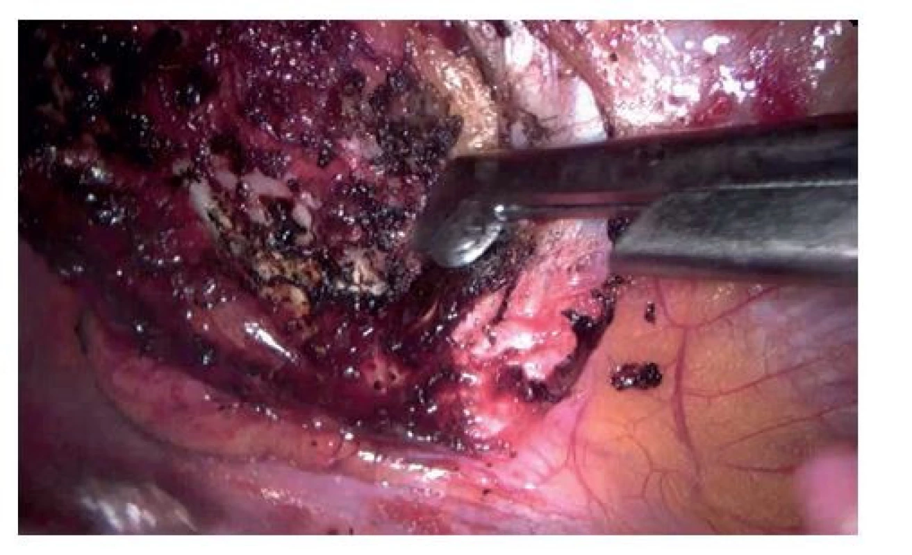 Přerušení úponu prvního žebra ke sternu laminektomickým
šídlem<br>
Fig. 2: The first rib was cut near the costoclavicular junction
using the neurosurgical punch