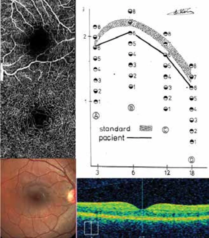 NPDR: CS, SD-OCT, OCT-A a fundus u pacientky 4
(Tabulka 2)