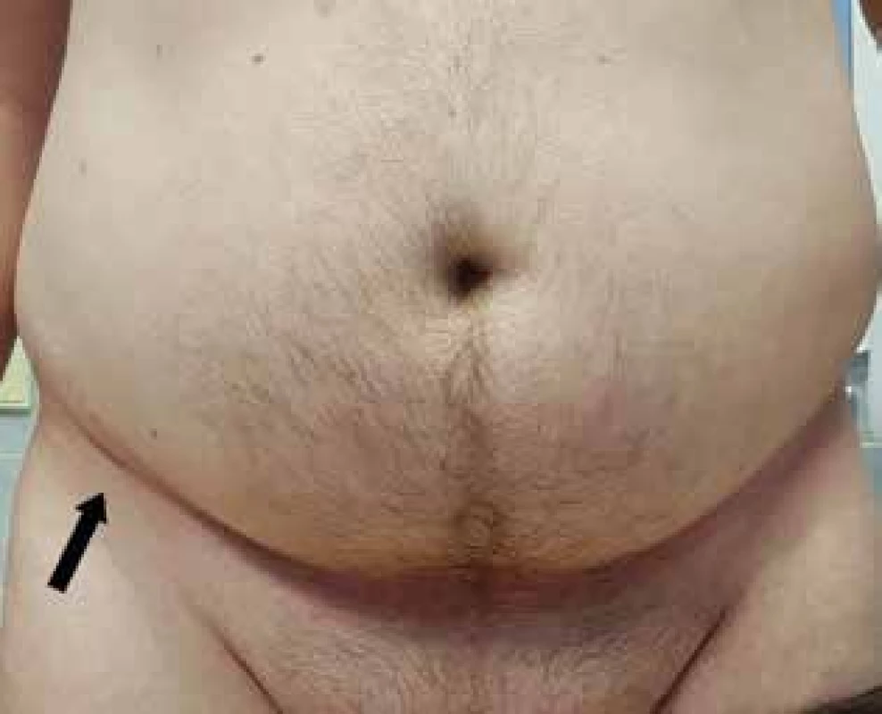 Habitus pacienta s meralgií
Nad pravým tříslem patrná jizva po zavedení
neurostimulátoru. Šipka ukazuje místo komprese nervu.<br>
Fig. 5: The appearance of a patient with meralgia
Above the right groin there is a scar following the
insertion of a neurostimulator. The arrow shows the nerve
compression site.
