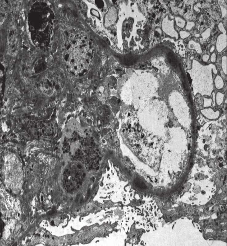 Histologický nález u pacientky č. 2. Elektronová mikroskopie s nálezem denzních depozit.<br> Fig. 3. Histological findings in patient 2. Electron microscopy with the findings of dense deposits.