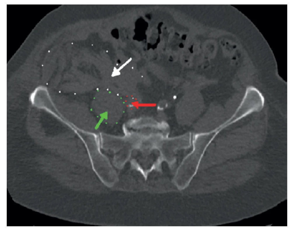 Netraumatické retroperitoneální krvácení (bílá
šipka) u 94leté pacientky, zelená šipka – musculus psas,
červená šipka − pánevní tepna<br>
Fig. 2: Non-traumatic retroperitoneal hemorrhage ( white
arrow) in a 94-year-old female patient, green arrow −
musculus psoas, red arrow − pelvic artery