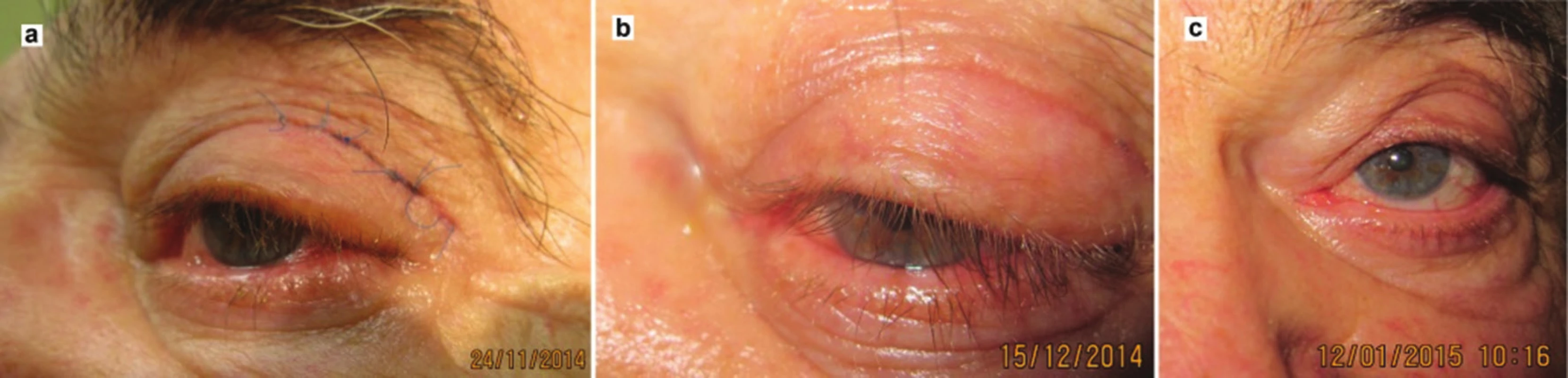 Clinical finding at follow-up examination: a) 2 weeks after removal of drain, b) 1 month after procedure, c) 2 months after procedure