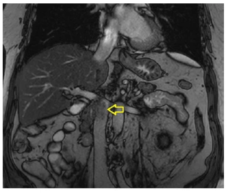 Nález recidivy tumoru na magnetické rezonanci <br> 
Fig. 1. MRI finding of the locally recurrent tumor
