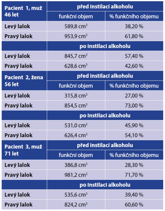 Volumetrie před a po instilaci absolutního alkoholu<br>
Tab. 2. Volumetry before and after absolute alcohol injection