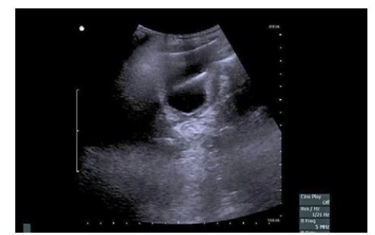 a. Akustický stín cizího tělesa v močovém
měchýři (krejčovská jehla) na sonografickém vyšetření<br>
Fig. 4a. Acoustic shadow of a foreign body in the
bladder (tailor's needle) on ultrasound examination